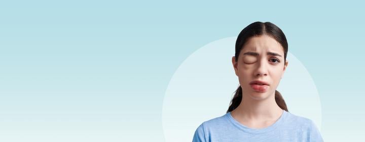 mädchen_mit_geschwollenem_auge