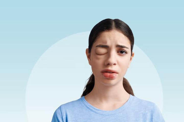 mädchen_mit_geschwollenem_auge